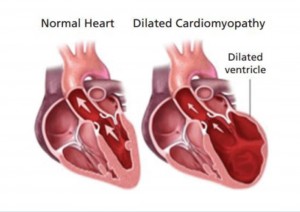 What is Dilated Cardiomyopathy?